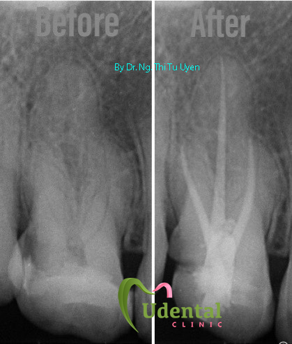 #root canal treatment